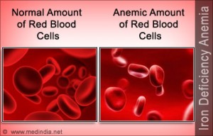 iron-deficiency-anemia
